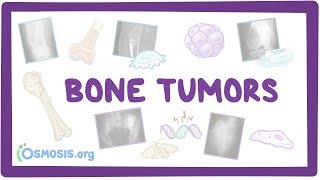 Bone tumors  causes symptoms diagnosis treatment pathology [upl. by Laban]