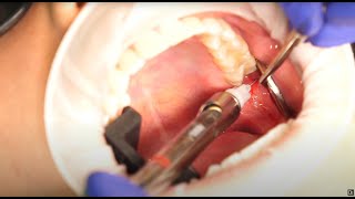 Gow Gates Nerve Injection Demonstration and Overview 4K [upl. by Marceau158]