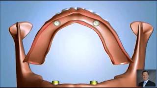 Two Implants  Locator Attachement for Denture [upl. by Nivej]