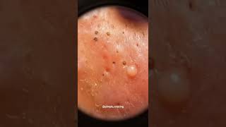 Blackheads Removal  Acne Treatment and Very Satisfying Satisfying Pimple pop blackheads [upl. by Akcired]