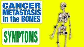 Cancer Metastasis in the Bones  All Symptoms [upl. by Russell]