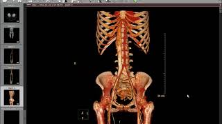 CT Angiography Case01 May Thurner Disease [upl. by Anthony]