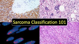 Sarcoma Classification 101 Soft Tissue Tumor Naming Made Simple for Beginners amp NonPathologists [upl. by Ericka]