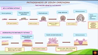 Pathogenesis of colorectal carcinoma  DrVShanthi [upl. by Neetsyrk]