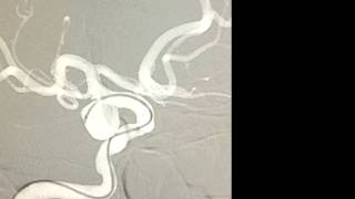 Endovascular coil embolization of unruptured posterior communicating artery aneurysm [upl. by Zena]