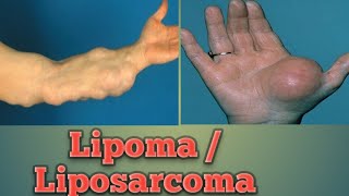 Lipoma  Liposarcoma Cancer Pathology Oncology Cancer [upl. by Gildus]