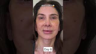 INSANE 2Week Facelift Healing and Recovery Process [upl. by Ennovyahs4]