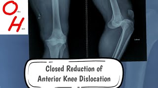 HOW TO REDUCE KNEE DISLOCATION [upl. by Giordano]