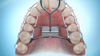 Hyrax Rapid Palatal Expansion Braces During [upl. by Ris]