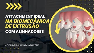 Attachment ideal para biomecânica de extrusão com Alinhadores [upl. by Altis]