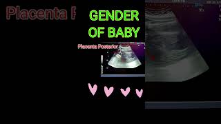 BABY GENDER VS PLACENTA shortsfeedpregnancy [upl. by Alston817]