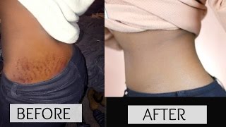 HOW TO GET RID OF STRETCH MARKS amp SCARS FAST [upl. by Mccutcheon]