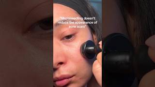 How to boost collagen elastin and improve texture and acne scars over time🙌🏽 microneedlingface [upl. by Enahs]