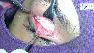 Ptosis Surgery Video amp Results1 Droopy Eyelid TreatmentCongenital Ptosis Faridabad Delhi India [upl. by Eirojam]