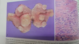 Leiomyoma  SPECIAL PATHOLOGY [upl. by Carly]