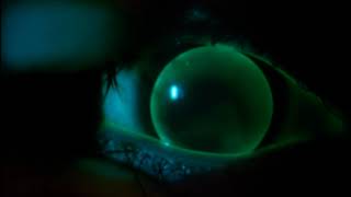 Instructional Video Assessment of a Gas Permeable Contact Lens [upl. by Odraboel990]