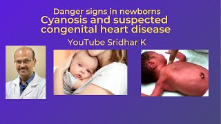 Cyanosis in a baby Suspected congenital heart disease Dr Sridhar K [upl. by Aivizt]