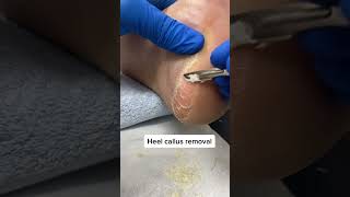 Uncover smooth skin underneath Watch how an Australian podiatrist tackles hard heel callus [upl. by Danni710]