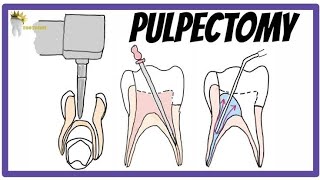 شرح علاج العصب الكلى فى الأسنان اللبنية pulpectomy in primary teeth [upl. by Airolg]