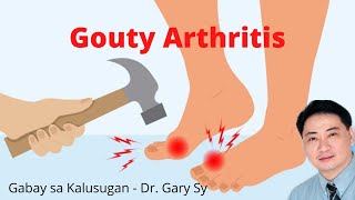 Gouty Arthritis  Dr Gary Sy [upl. by Geraint]