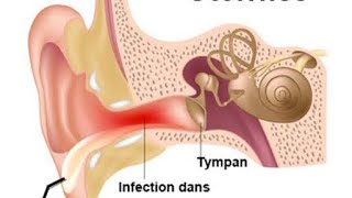 📍Pathologies de loreille externe 🔥 [upl. by Lomasi262]