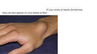 Ganglion Cysts Causes Symptoms and Treatment Optionsquot [upl. by Phaidra]