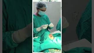 Excision of Ranula  Surgery  Ranula treatment  Dr Ranjana Butola [upl. by Yhtomot]