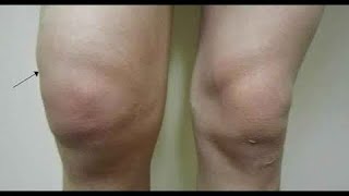 كيف نتخلص من ماء الركبة وإنصبابهاKnee joint effusion الدكتور عقبة نافع الناصري Uqba N Yousif [upl. by Skricki422]