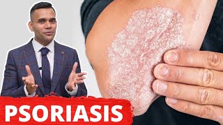 Psoriasis Treatment  The Best 2 Remedies For Psoriasis [upl. by Christa]