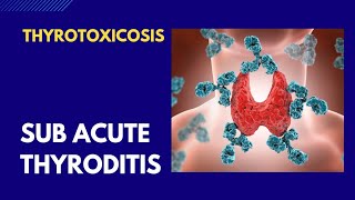 Thyrotoxicosis  Thyroiditis [upl. by Iggam531]