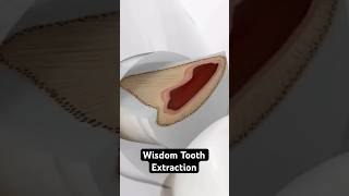 Wisdom Tooth Extraction 3D Animation [upl. by Price]