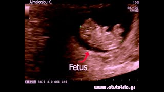 9 weeks pregnancy sonography [upl. by Nirrak]