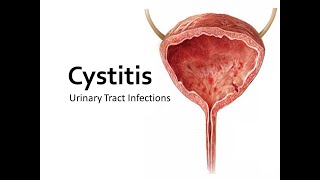 Cystitis lecture [upl. by Alain]