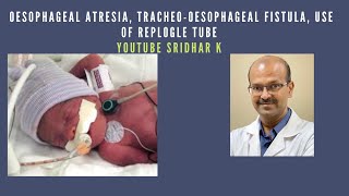 Oesophageal atresia Tracheo oesophageal fistula use of replogle tube replogletube tef [upl. by Miehar237]