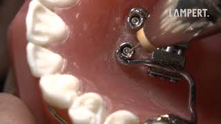 PUK Welding  palatal implants [upl. by Fulvi]