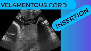 Velamentous Cord Insertion on Ultrasound Scan [upl. by Nnednarb]