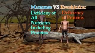 Marasmus Difference Between Marasmus Cachexia and Kwashiorkor [upl. by Sahc355]