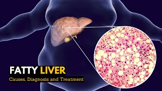 Fatty Liver Causes Signs and Symptoms Diagnosis and Treatment [upl. by Lindbom]