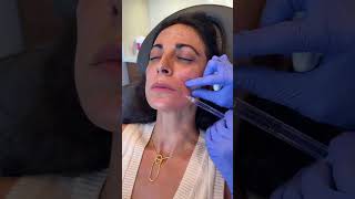 Full Face Sculptra and Filler dermalfillers filler sculptra [upl. by Alesi]