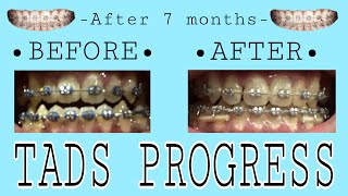 TADS PROGRESS  After 7 months😬🦷🪥 [upl. by Malinin]