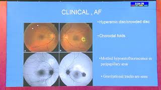 AIOC2020 IC395 T4 Dr Awaneesh Upadhyay Emerging concept of Peripapillary Pachychoroid Syndrome PPS [upl. by Vaules758]