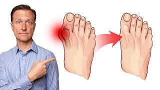 How to Fix Bunions in 3 Steps [upl. by Libnah]