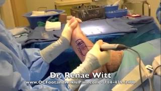 The Topaz Procedure for Treatment of Plantar Fasciitis Dr Renae Witt DPM [upl. by Inge]