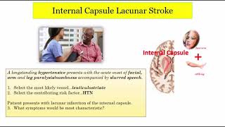 12DaysinMarch Stroke Localization Lacunar Infarcts Part 2 of 3 for the USMLE Step One Exam [upl. by Gaillard]