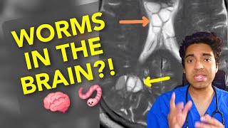 Worms in the BRAIN 🧠🪱 Doctor explains neurocysticercosis from undercooked pork 🐖 [upl. by Honeywell]