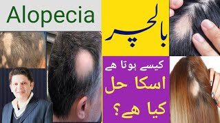 Alopecia Areata  balchar Symptoms  Treatment  Regrowth of Hairs  Hairfall Reasons  Hindi urdu [upl. by Anizor]