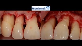 Periodontal Surgery with Regeneration for Upper Teeth [upl. by Natassia601]