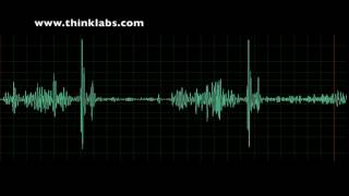 Atrial Septal Defect large secundum [upl. by Letsirk16]