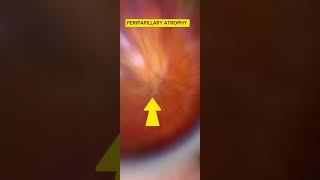 Peripapillary ATROPHY myopic fundii [upl. by Asabi]