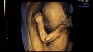 3D ultrasound 25 weeks 4D view of baby 25 week pregnancy baby girl first view [upl. by Eednarb112]